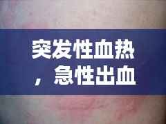 突发性血热,急性出血热咋引起的